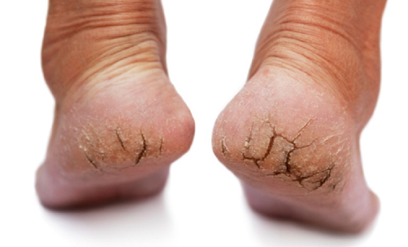 تشققات القدمين