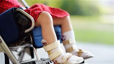 الصحة تكشف أسباب وأعراض الإصابة بمرض شلل الأطفال