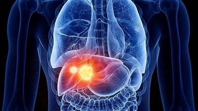 أعراض تحذيرية تظهر قد تدل على مرض خطير في الكبد