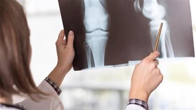 احذر من هذه الأطعمة قد تسبب لك هشاشة العظام!