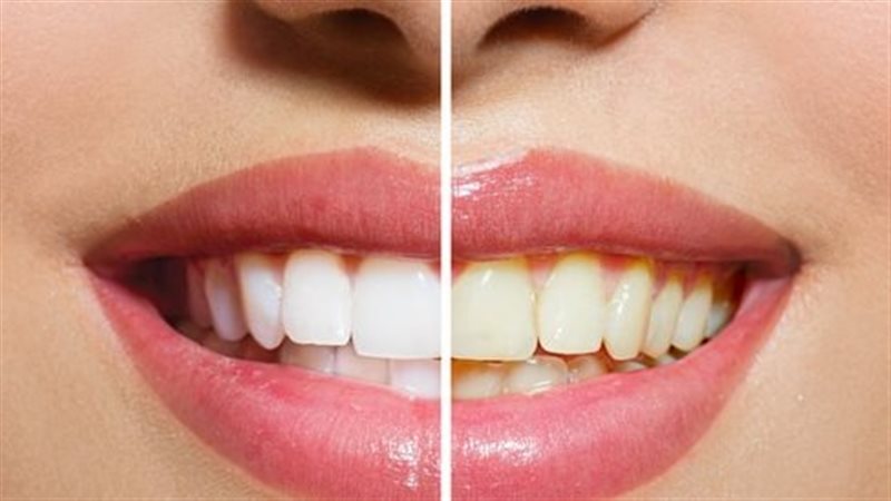 طرق لتبيض الأسنان