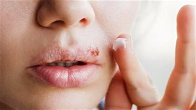 هل يمكن أن يؤثر فيروس الهربس الفموي على الجهاز العصبي؟