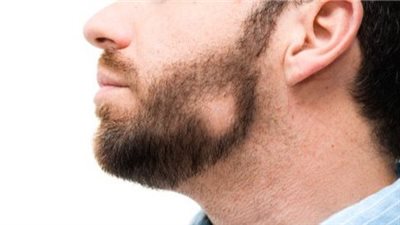 أفضل الطرق الطبيعية للتخلص من ثعلبة الذقن