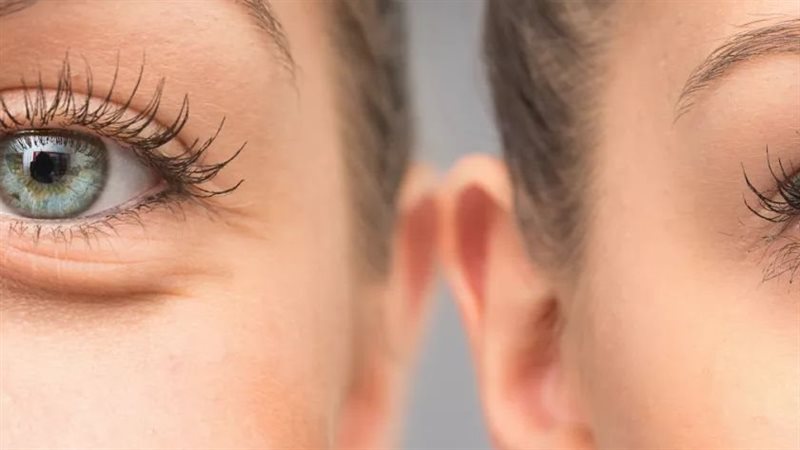 تجاعيد العين