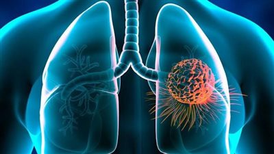 الصحة توضح حقائق هامة حول علاج سرطان الرئة