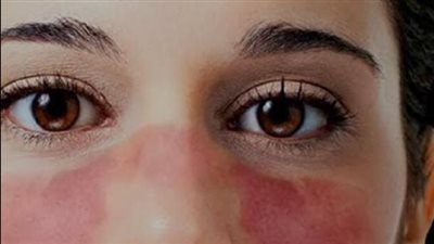 مرض الذئبة الحمراء أسبابه وأعراضه وكيفية التعايش معه