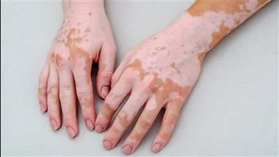 تعرف على أسباب البهاق وأعراضه وأهم طرق العلاج