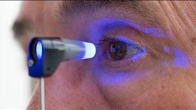 إشارات تحذيرية تكشف إصابتك بالجلوكوما.. انتبه لها قبل فوات الأوان