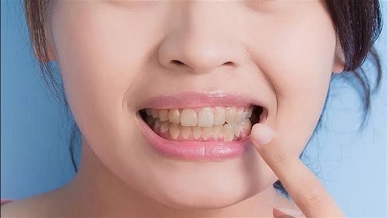 تصبغات الأسنان 