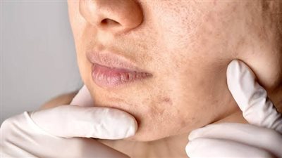 السبب الحقيقي وراء ظهور الكلف الأسباب وطرق العلاج.. أشعة الشمس أم الشاشات؟