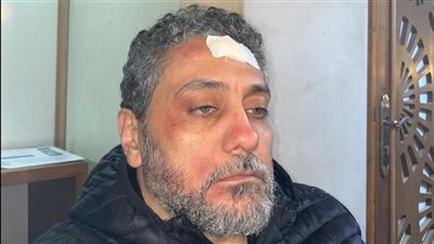 وحدة إضاءة تصيب الفنان تامر فرج أثناء تصوير أحدث أعماله