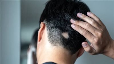 أفضل الطرق لعلاج الثعلبة بالزيوت الطبيعية والأدوية.. تعرف عليها