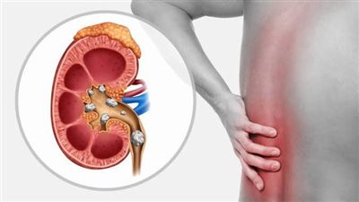 كل ما تحتاج معرفته عن حصى الكلى: الأسباب والأعراض وطرق العلاج