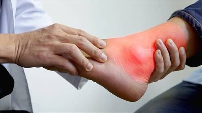 لا تهملها.. تعرّف على أهم أعراض النقرس المبكرة للسيطرة عليه سريعاً