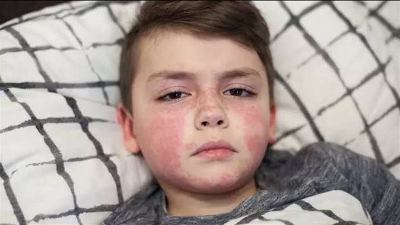 الحمى القرمزية