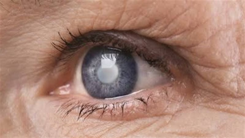 المياه البيضاء