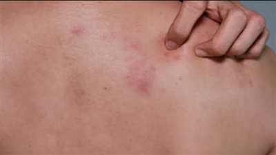 لمن فوق الخمسين.. تعرف على مخاطر الحزام الناري ومضاعفاته لدى كبار السن