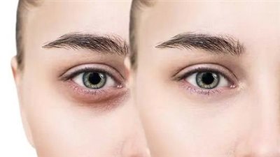 منها الكركم.. وصفات طبيعية لإزالة الهالات السوداء تحت العين