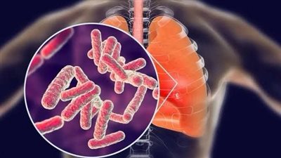 اليوم العالمي للسل.. أبرز الحقائق وأهم الأعراض وطرق الوقاية