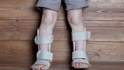 الكساح.. مرض صامت يضعف العظام اكتشف أسبابه الخفية وأعراضه المبكرة