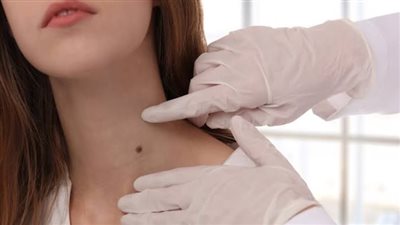 ظهور خطوط داكنة في الرقبة؟.. قد تكشف عن مشكلة صحية خطيرة