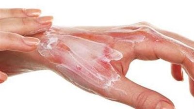 ودعي الحلول الخاطئة.. الطريقة الآمنة للتعامل مع حروق الزيت في المطبخ