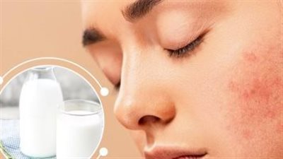 من حب الشباب لبهتان البشرة.. 6 أطعمة تفسد بشرتك وتسرّع المشاكل الجلدية 