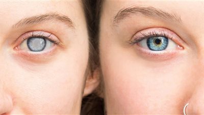 احذر هذه العلامات.. قد تكون إشارة لإصابتك بـ«الميه البيضا» على العين