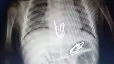 نجاح طبي بسوهاج الجامعي.. استخراج دبوس من معدة طفل دون جراحة