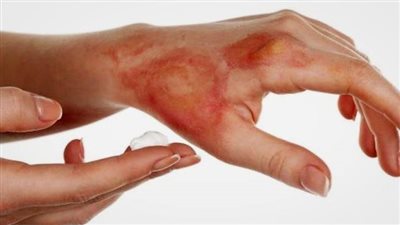 احذر وضع الثلج على الحروق.. «عادة شائعة» قد تُفاقم الألم وتؤخر الشفاء