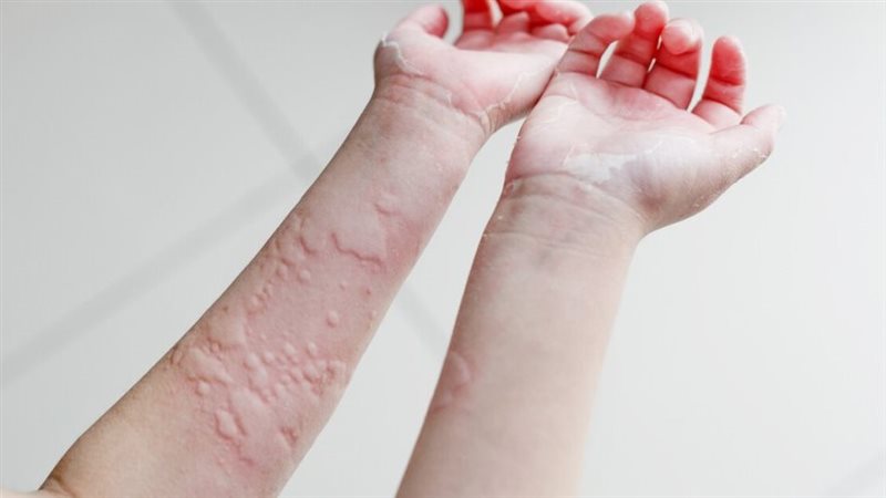 حساسية الماء 