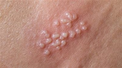 مع بداية الصيف.. تعرف على «بثور الشمس» وأفضل طرق الوقاية منها 