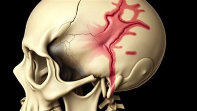 عملية نادرة بمستشفى السنبلاوين بالدقهلية تعيد الحياة لمريضة عانت من نزيف بالمخ