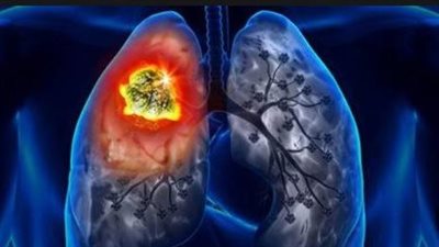 انتبه لصحتك.. أعراض سرطان الرئة وكيفية اكتشاف انتشاره مبكرًا
