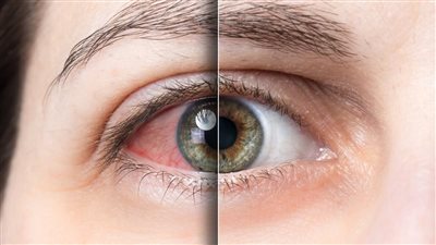 كل ما تريد معرفته عن «إنفلونزا العيون» وأهم طرق التشخيص والعلاج