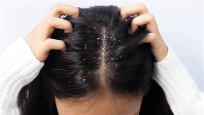 لتحقيق أفضل نتائج علاجية.. كيفية التمييز بين قشرة الشعر العادية وقشرة الجفاف