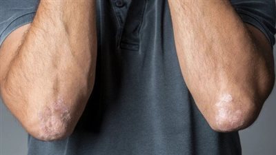 «الصدفية».. كيف تميز بين الأعراض المؤقتة والمرض المزمن؟ 