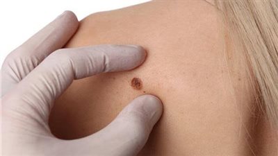 متى تتحول «الزوائد الجلدية» إلى ناقوس خطر لمقاومة الأنسولين؟