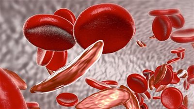 أفضل أطعمة طبيعية تقي من «فقر الدم» وتساعد في علاجه 