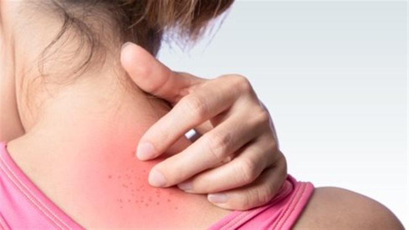 التهاب الجلد 