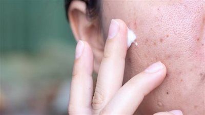 وصفات طبيعية فعالة لإزالة «آثار الحبوب» وتوحيد لون البشرة