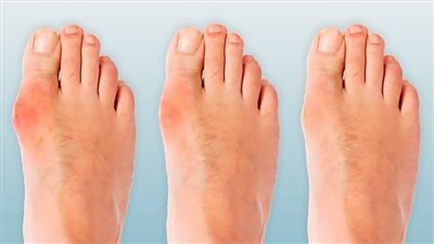 «عظمة الوكعة» في القدم.. ما أسباب ظهورها وكيف يمكن علاجها؟