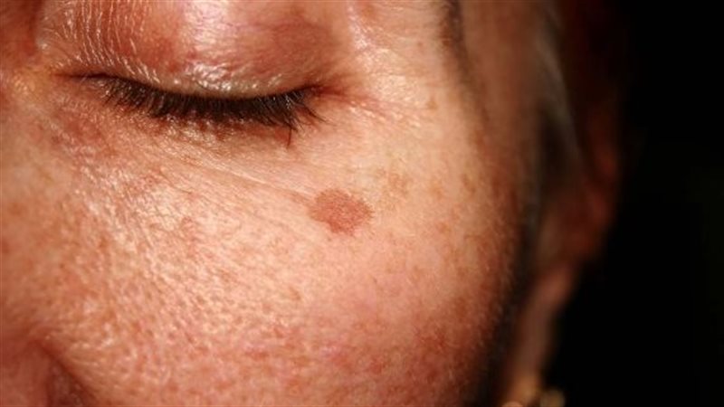 بقع الشيخوخة 