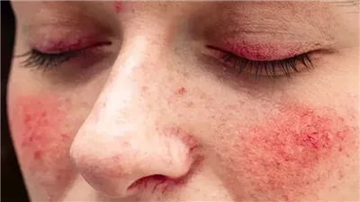 تشخيص وعلاج «الذئبة الحمراء » أخطر أمراض المناعة الذاتية