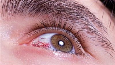 «عوائم العين».. علامات تستدعي استشارة الطبيب 