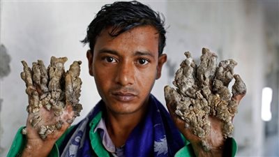 «متلازمة الرجل الشجرة» تحول الجلد لهيئة لحاء الأشجار 