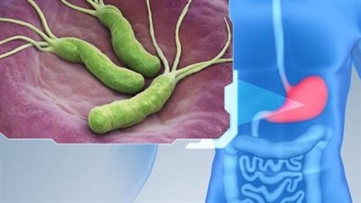 أغذية ومشروبات تجنبها خلال فترة علاج «جرثومة المعدة»