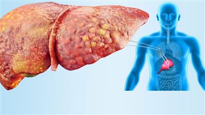 خمسة أعراض تكشف إصابتك المبكرة بـ «الكبد الدهني»