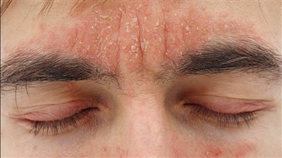 أفضل طرق تخفيف وعلاج أعراض «إكزيما الوجه»