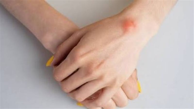 الأكياس العقدية